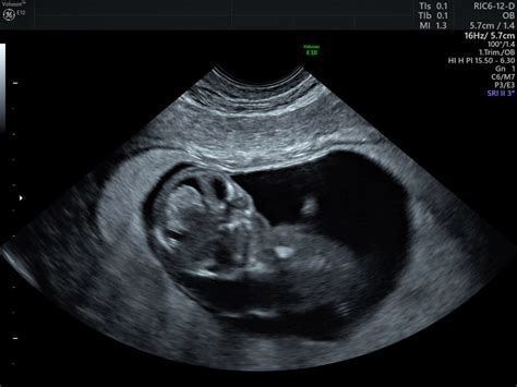 ultrasonda 3 çizgi görüntüsü